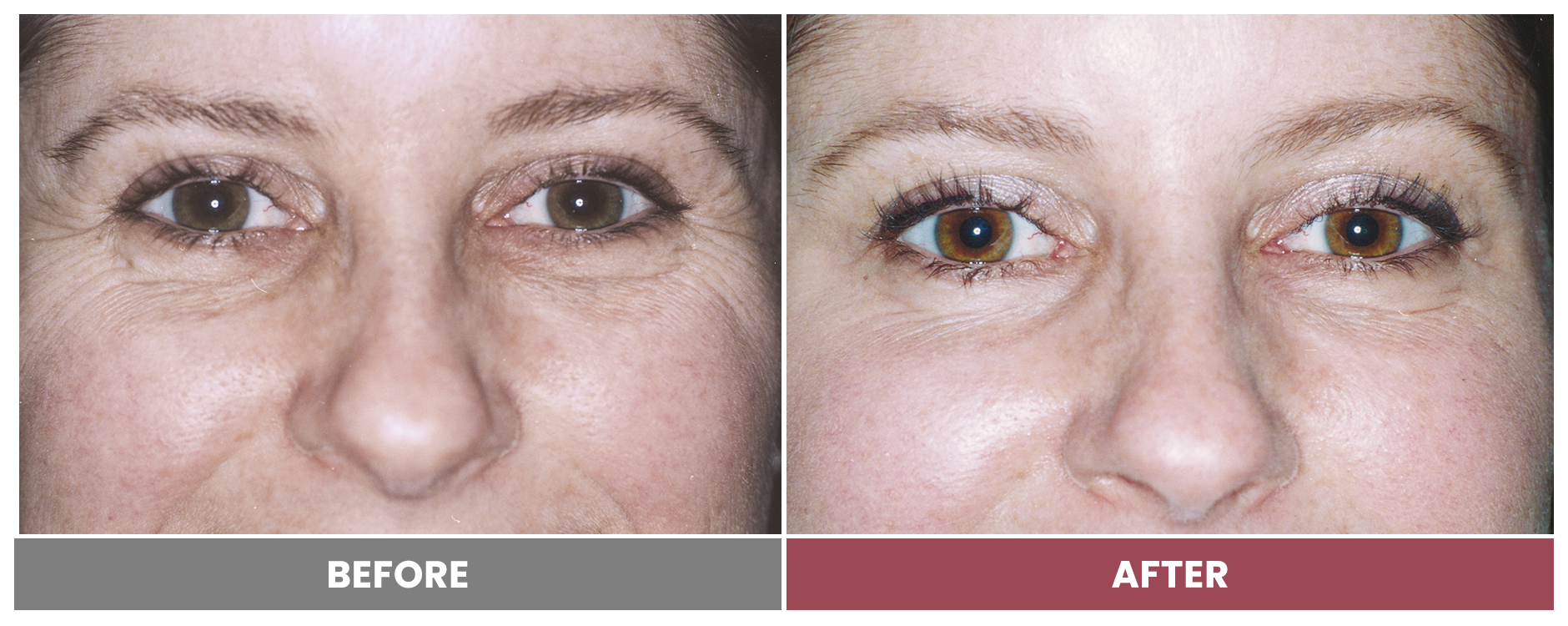 LASER SKIN RESURFACING - Case 3